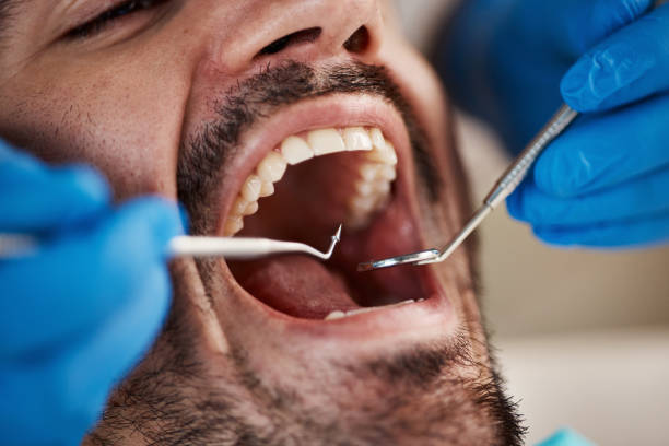 Best Knocked-Out Tooth (Avulsed Tooth) Treatment in Basile, LA